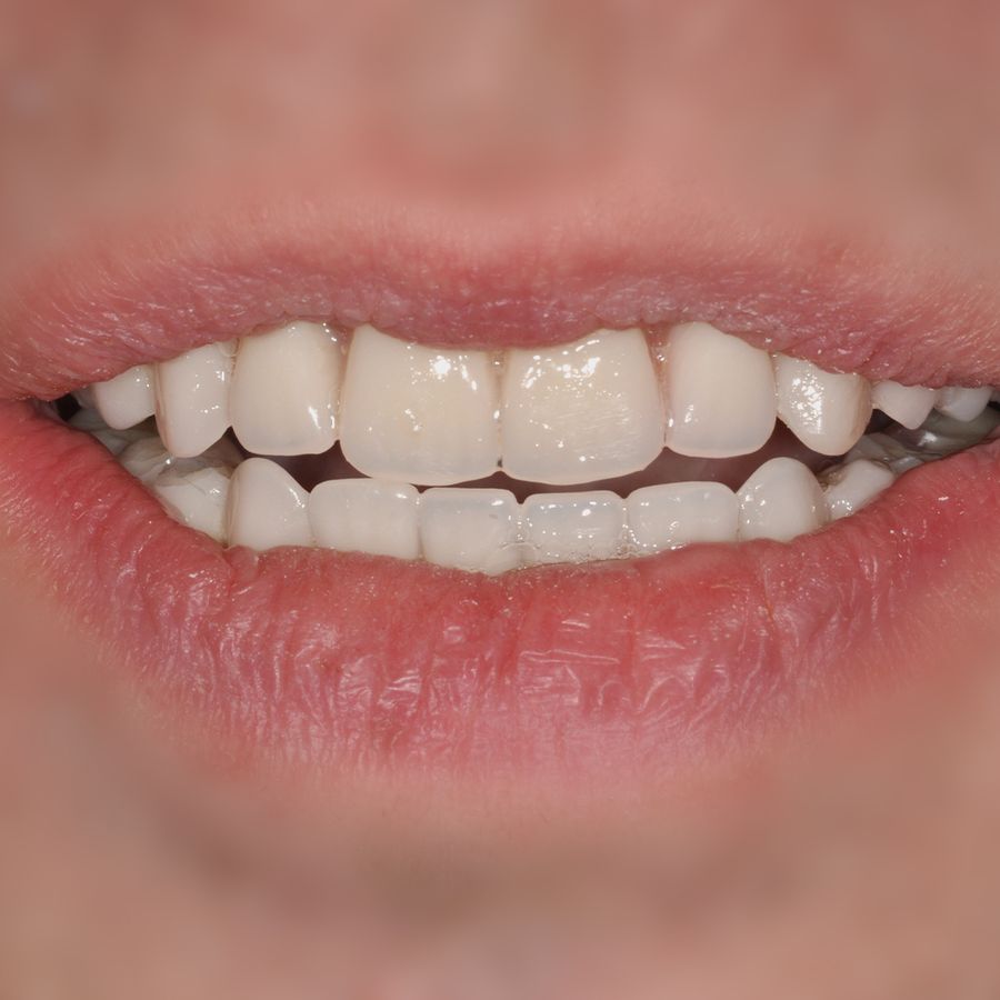 Teeth in a Day Procedure - After - 3Dental